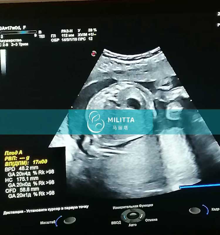 乌克兰试管妈妈孕17周B超