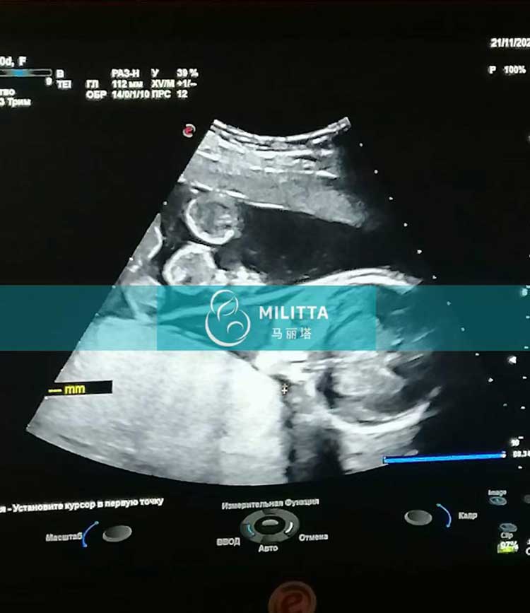 乌克兰试管妈妈孕17周B超