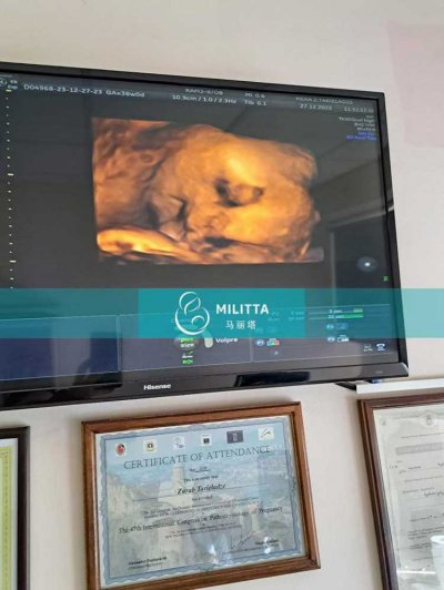 格鲁吉亚试管妈妈在当地妇产医院做B超产检，胎儿已经长大