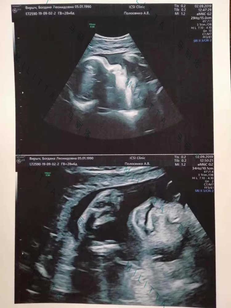 乌克兰代妈四维彩超