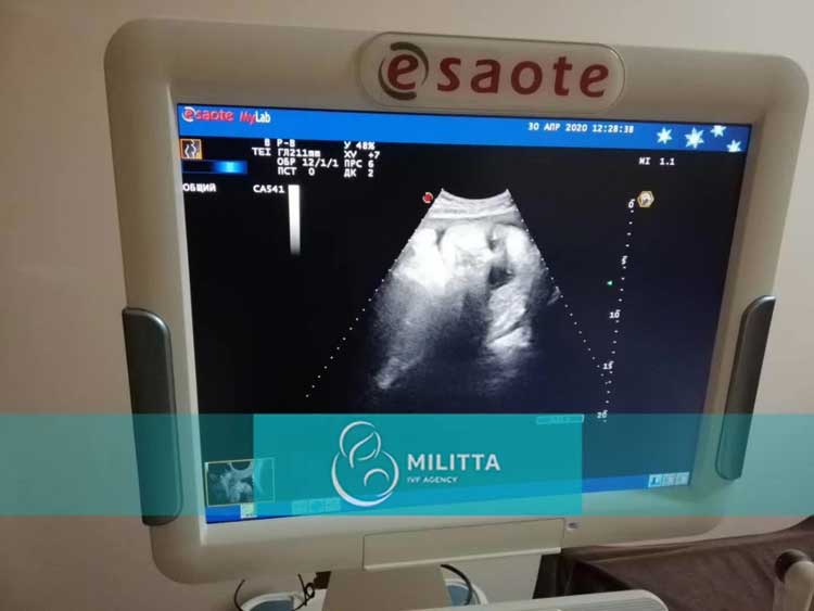乌克兰代母做产检