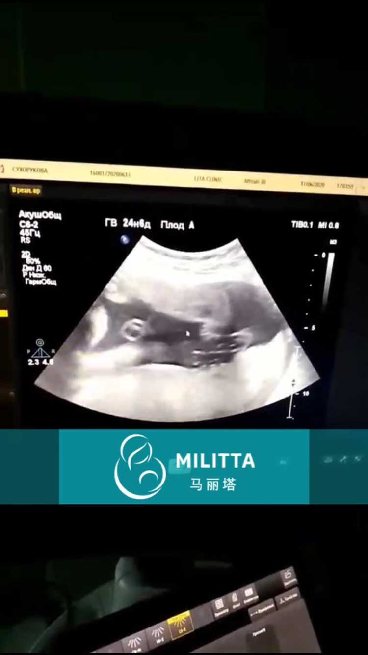 乌克兰代妈做产检