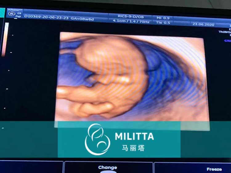 乌克兰马丽塔代妈产检