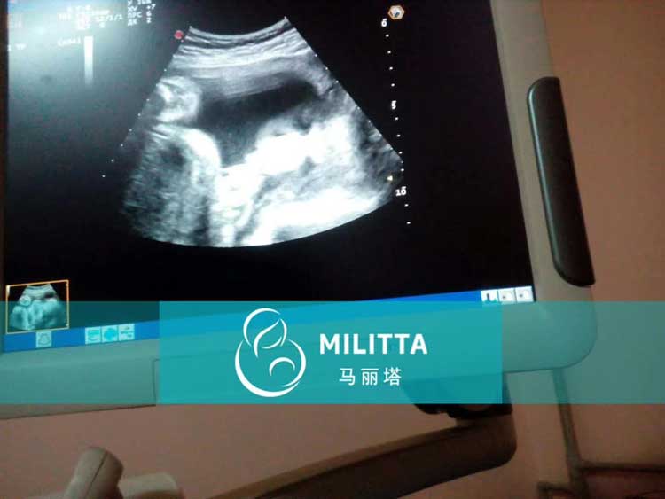 乌克兰代妈做产检