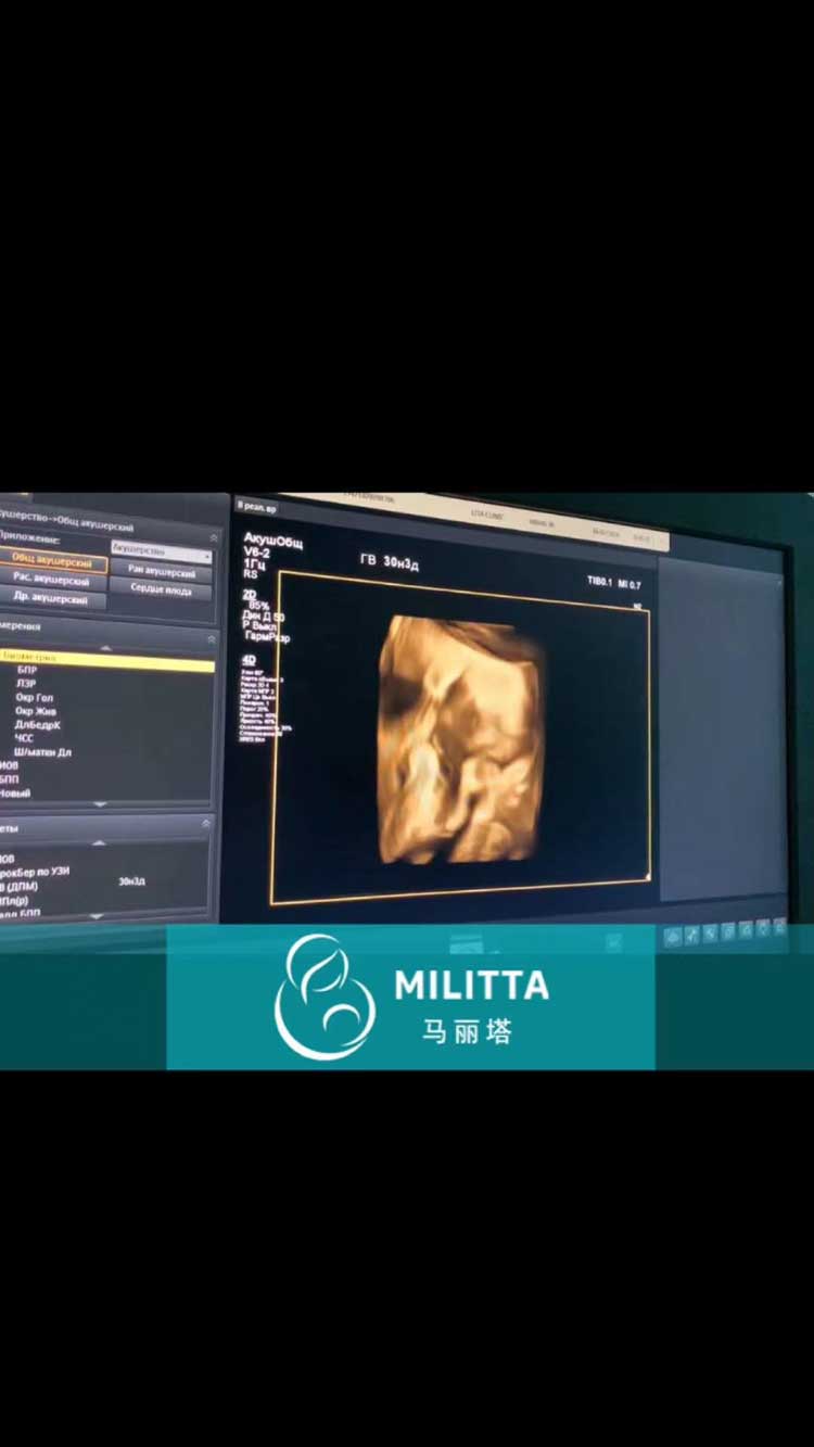 乌克兰代妈到医院做四维彩超