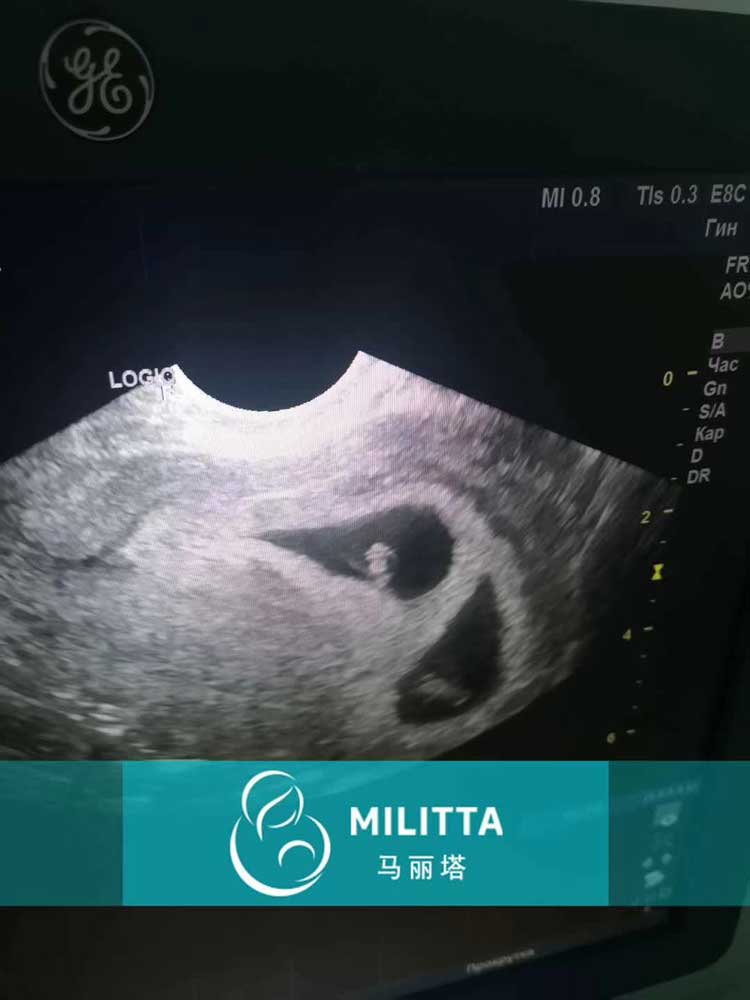 乌克兰代妈B超验孕