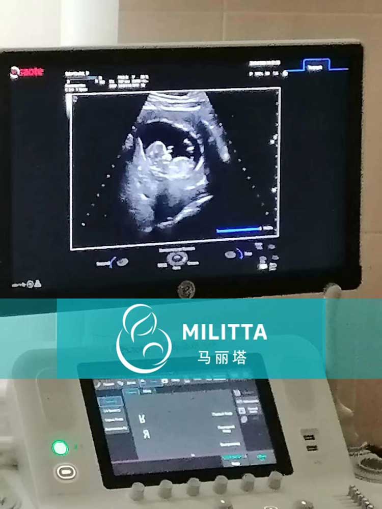 乌克兰代妈做B超
