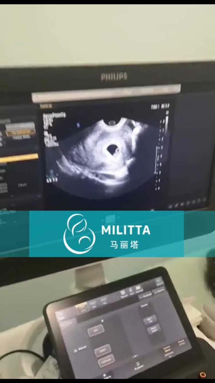 乌克兰代妈一次试管移植成功