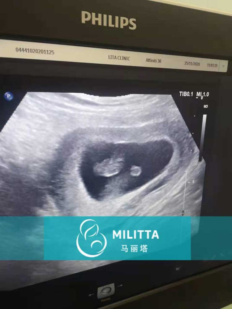 马丽塔代妈孕后第二次检查