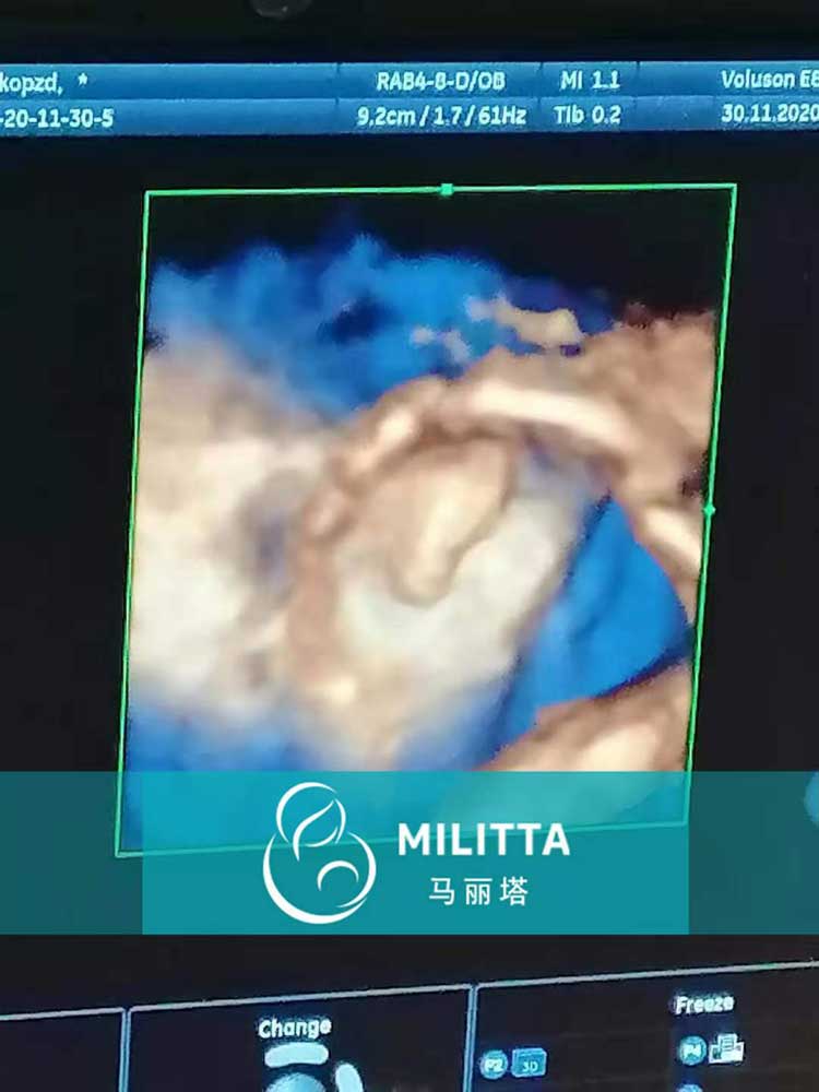 乌克兰代妈做四维彩超