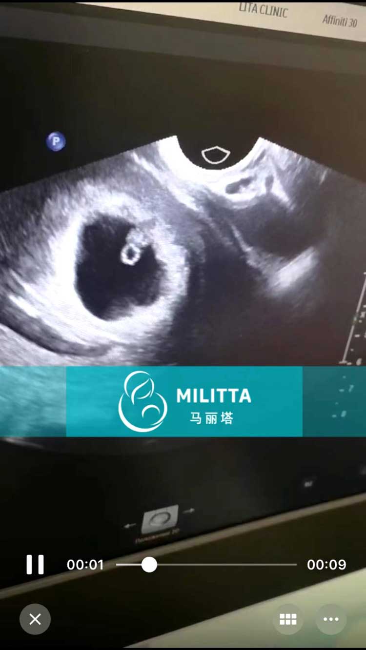 乌克兰代妈到医院做B超