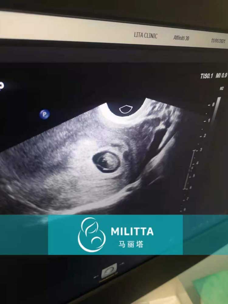乌克兰代妈第一次B超