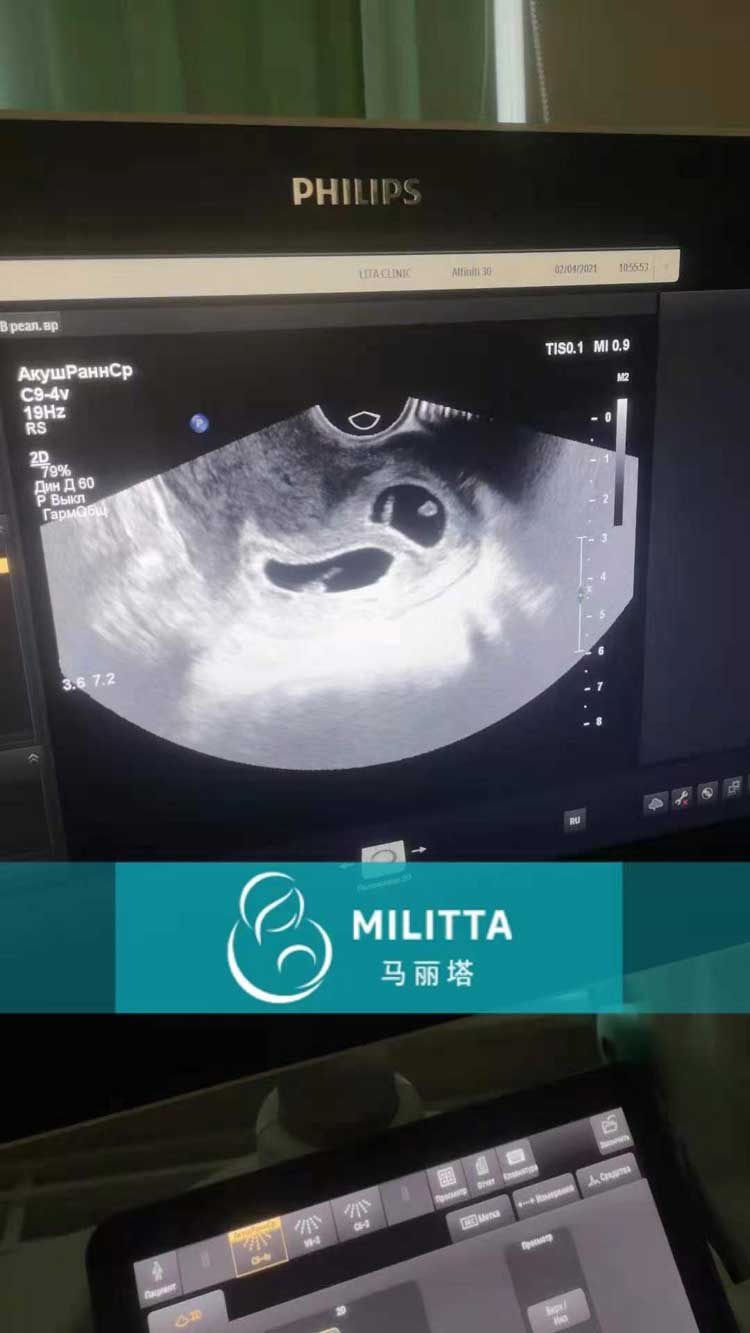 乌克兰代妈做产检