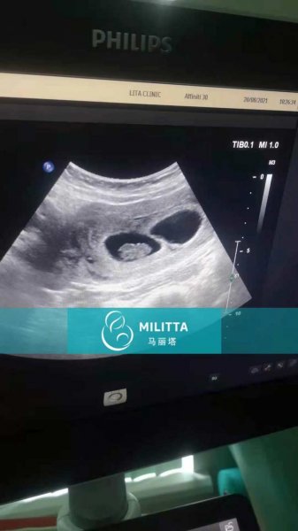 乌克兰代理孕母在医院做产检,有的孕妈怀的是双胎