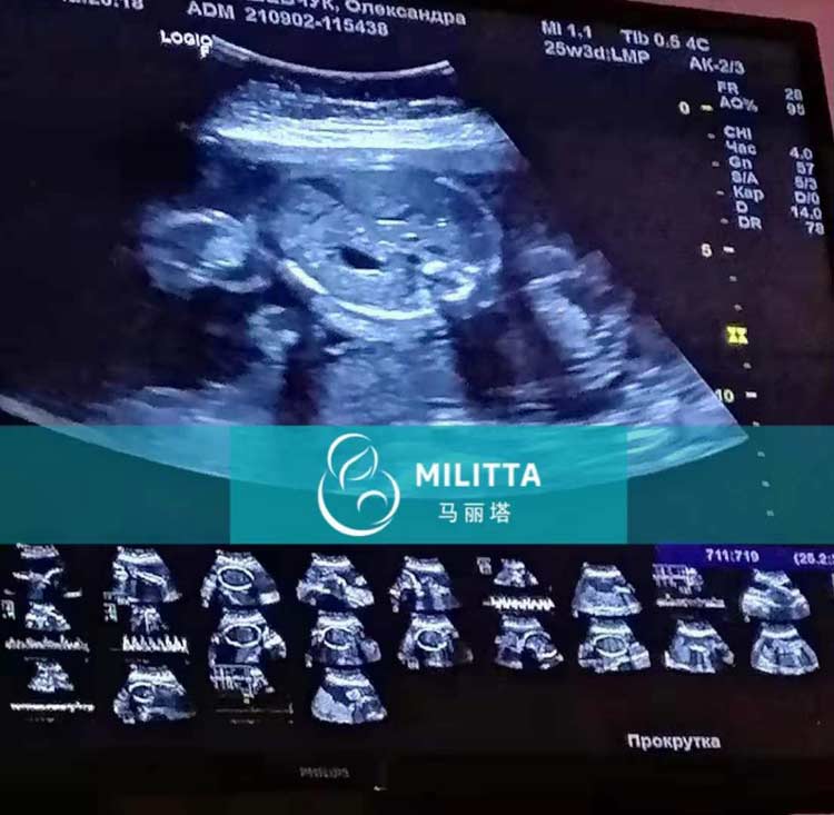 乌克兰试管孕妈做产检
