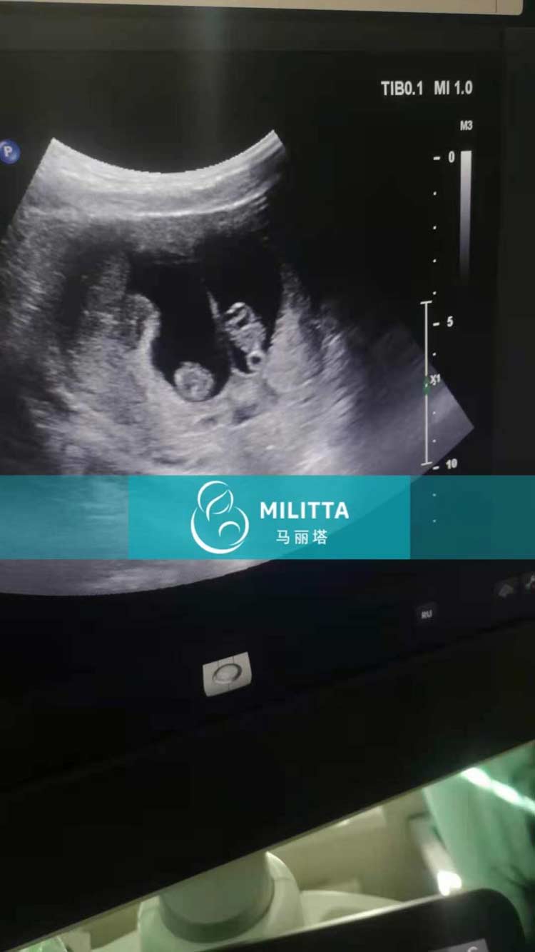 乌克兰试管孕妈做产检