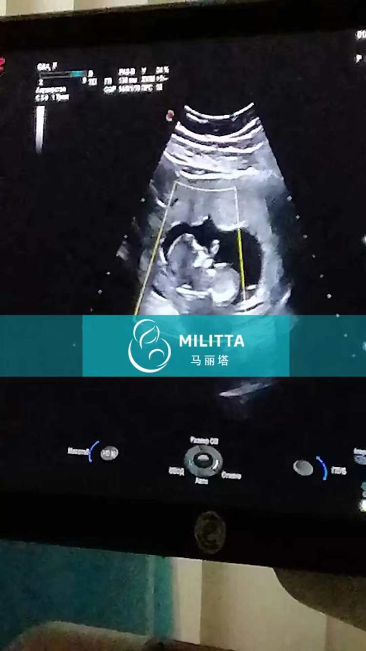 马丽塔孕母做产检