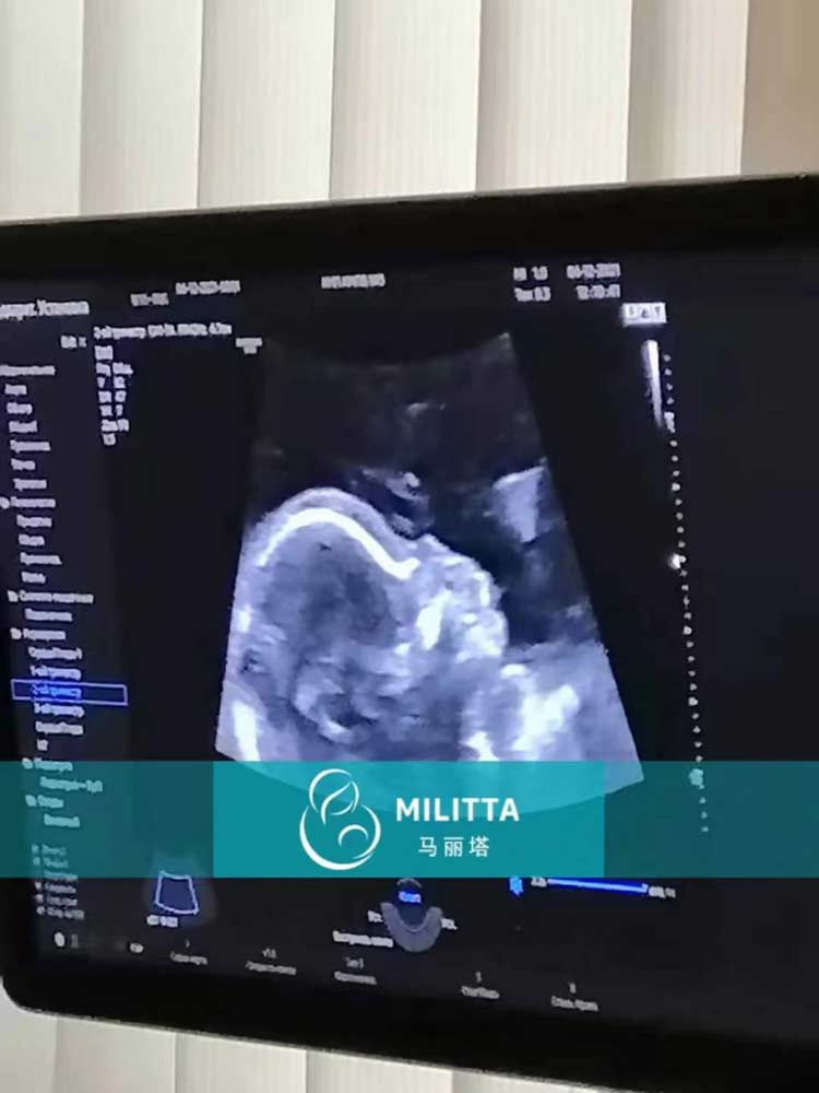 乌克兰代理孕母做产检