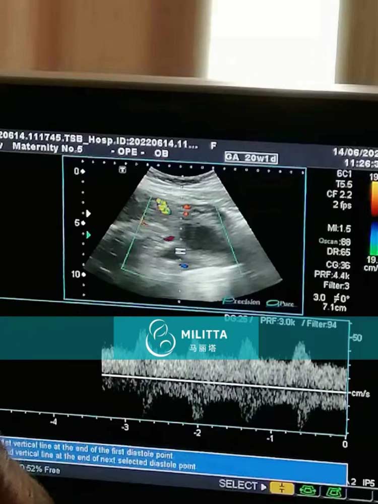 孕16周的乌克兰试管妈妈
