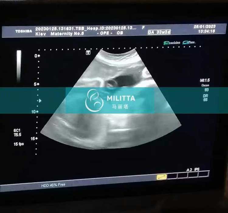 乌克兰孕33周孕妈做B超