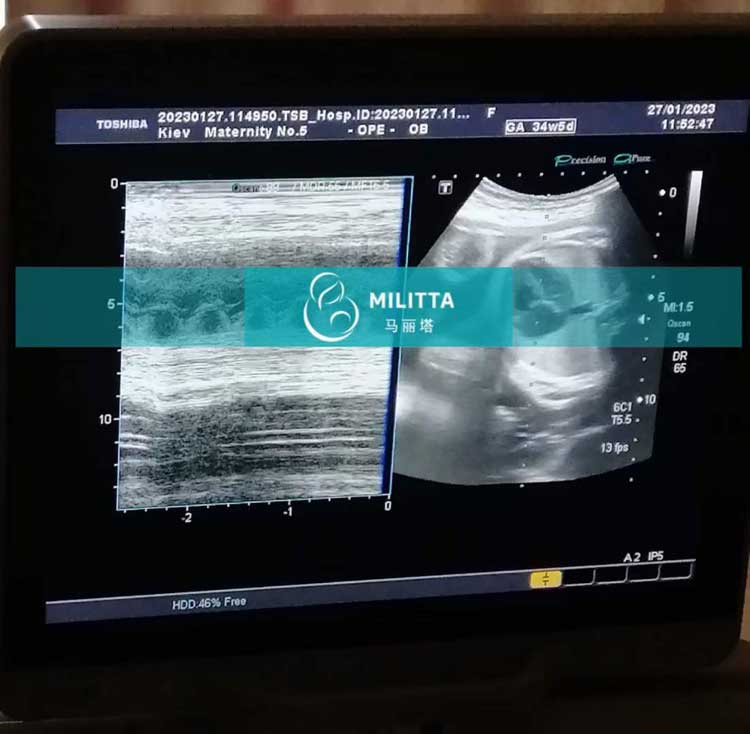 乌克兰孕34周孕妈做B超