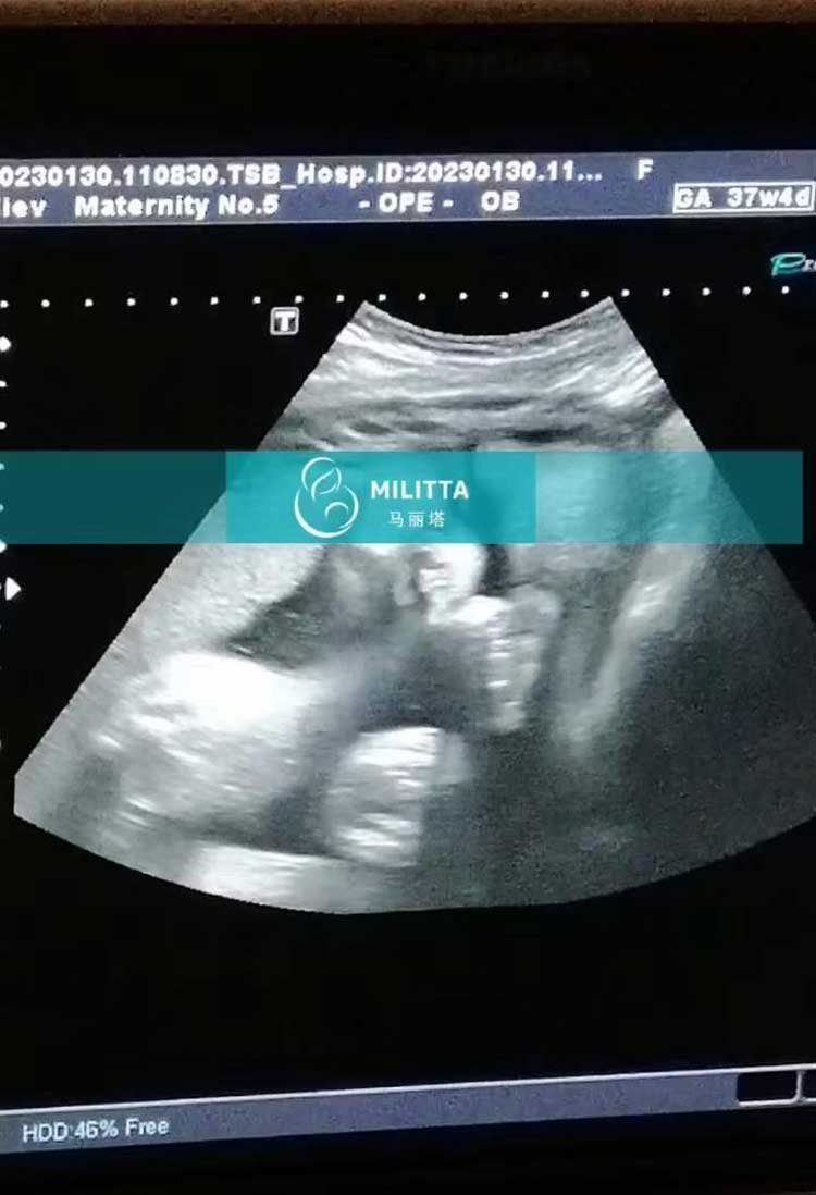 乌克兰孕37周孕妈做B超