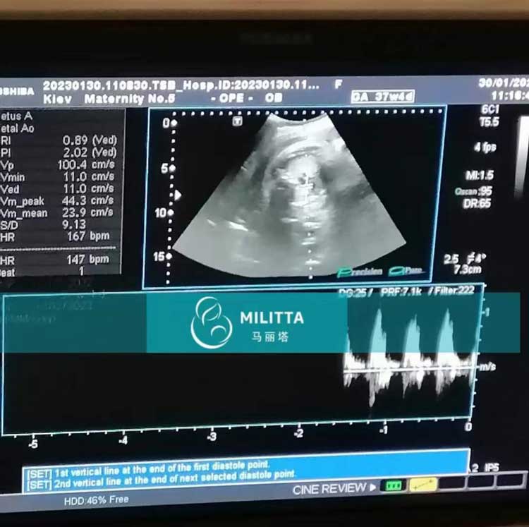 乌克兰孕37周孕妈做B超