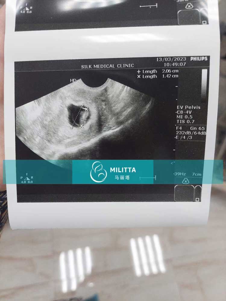 格鲁吉亚silk医院的孕妈B超