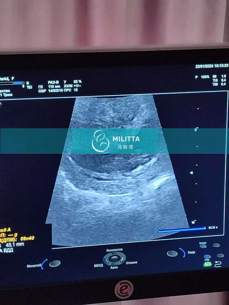 乌克兰试管妈妈B超
