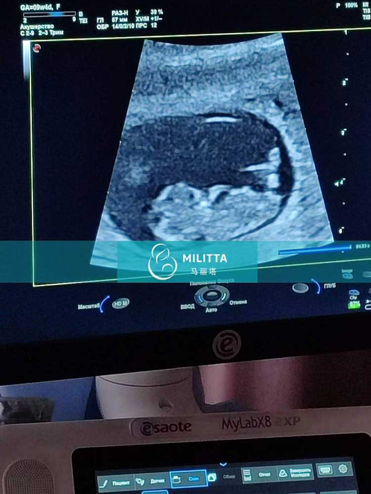 乌克兰试管妈妈产检