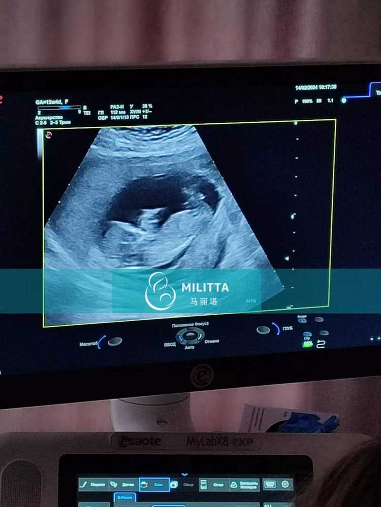 乌克兰试管妈妈孕12周B超
