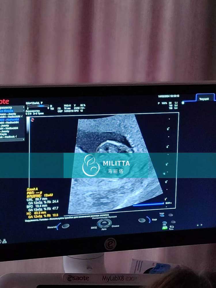 乌克兰试管妈妈孕12周B超