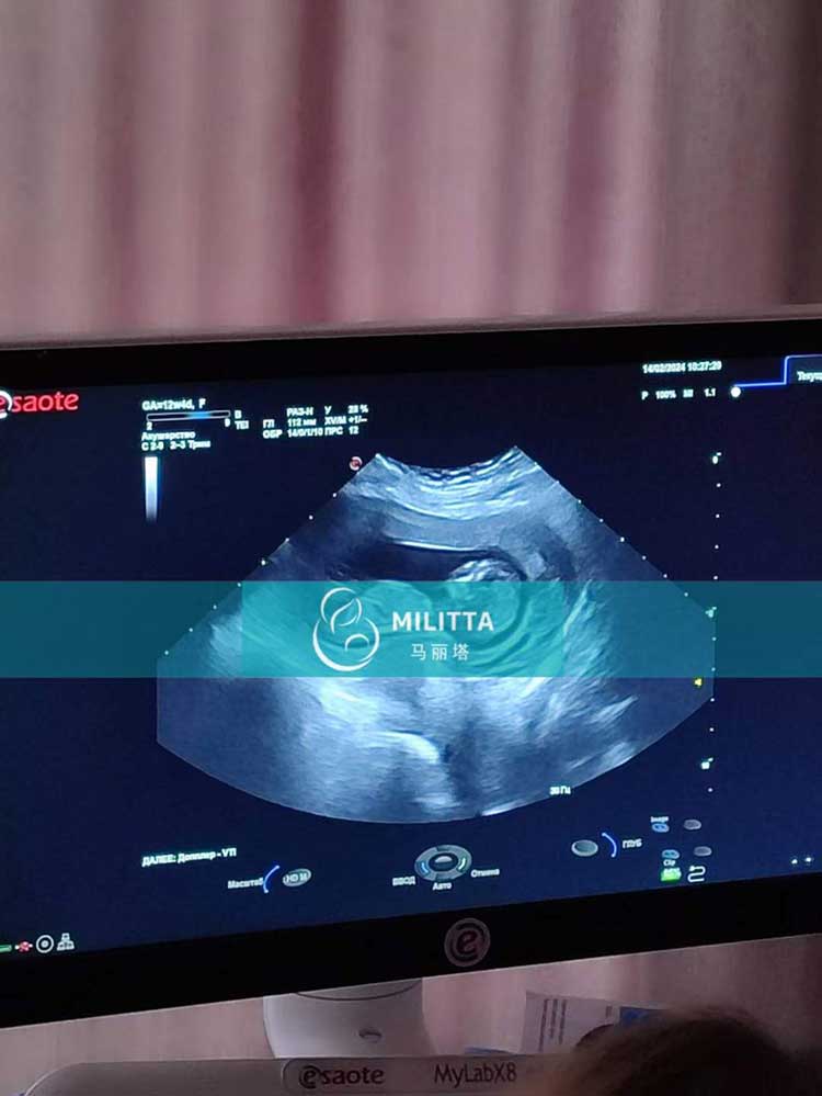 乌克兰试管妈妈孕12周B超