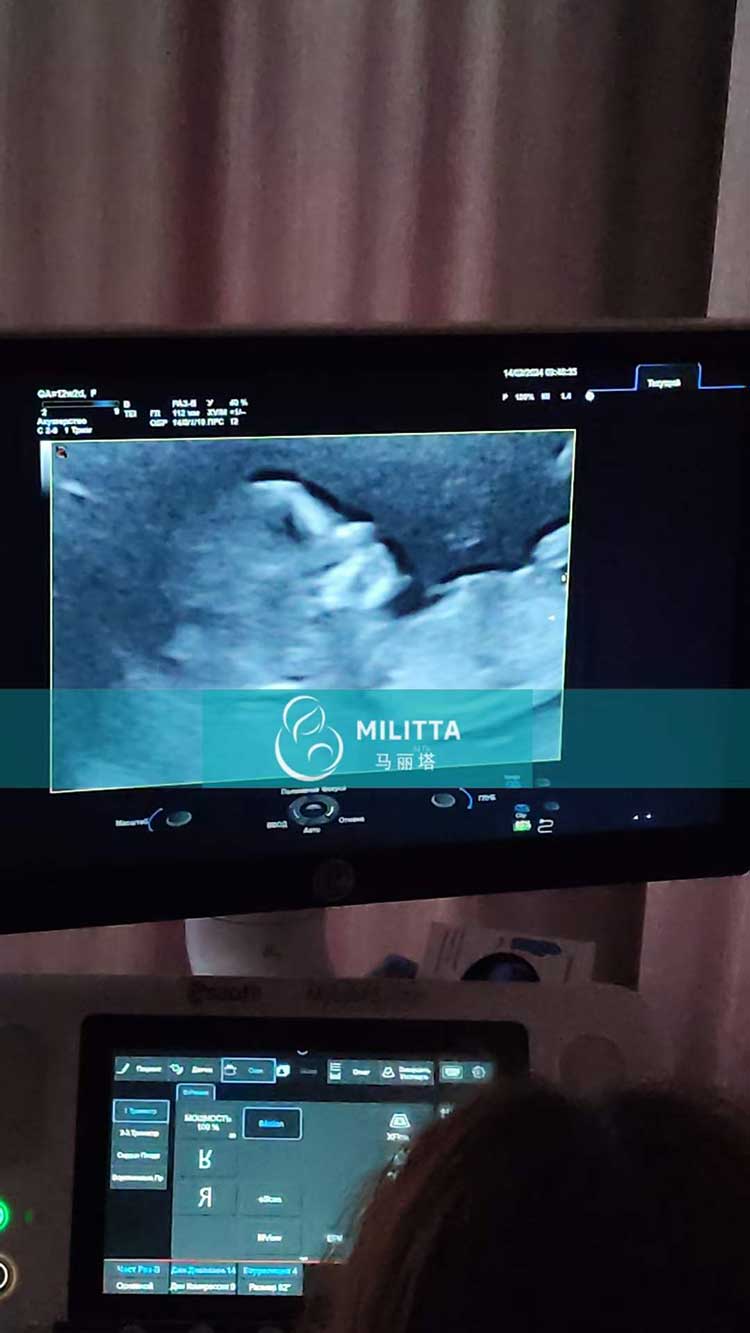 乌克兰试管妈妈孕12周B超
