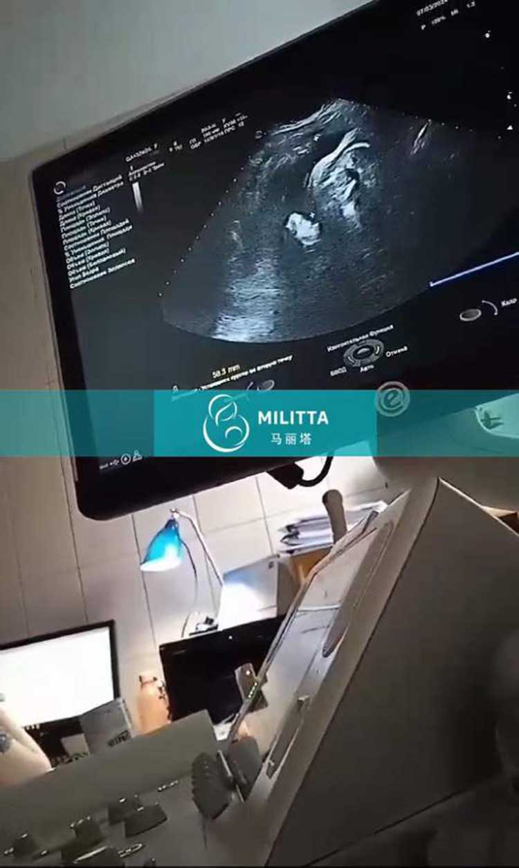 乌克兰试管妈妈做B超孕检