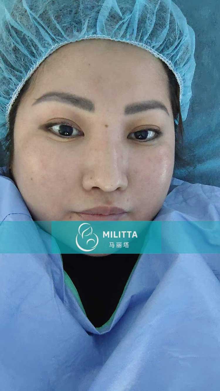 哈萨克斯坦试管妈妈移植胚胎