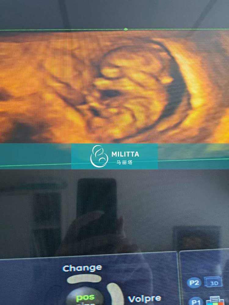 试管妈妈孕10周B超