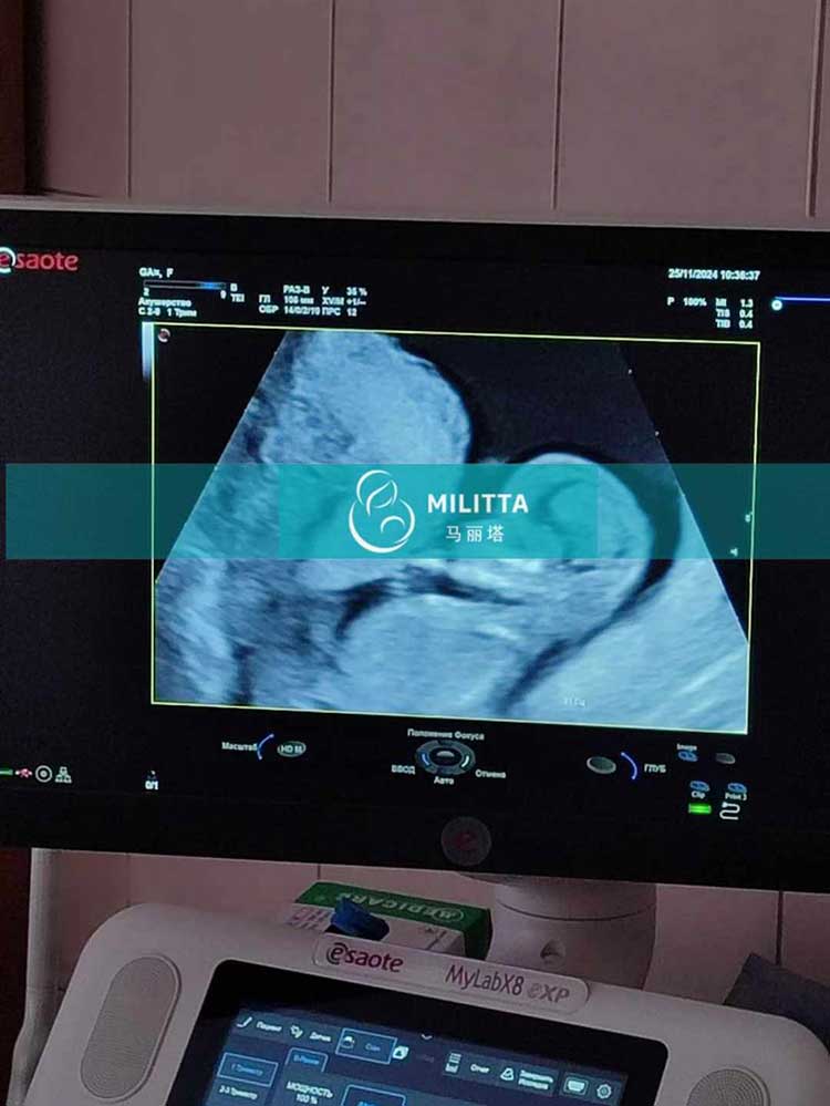 试管妈妈孕12周B超