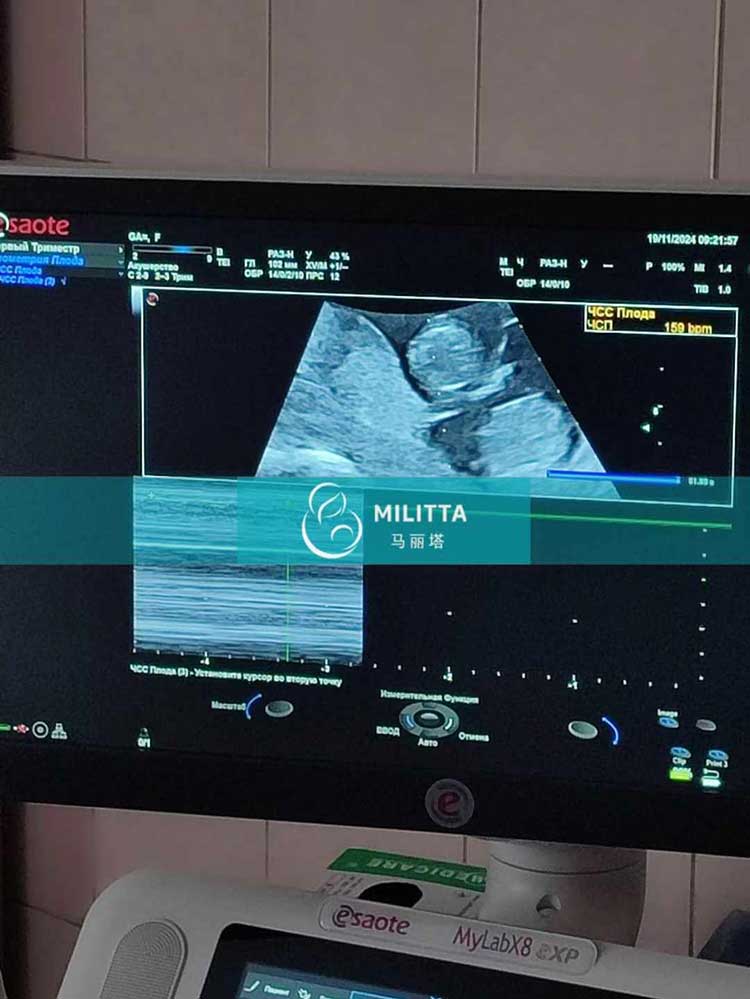 乌克兰试管妈妈孕13周