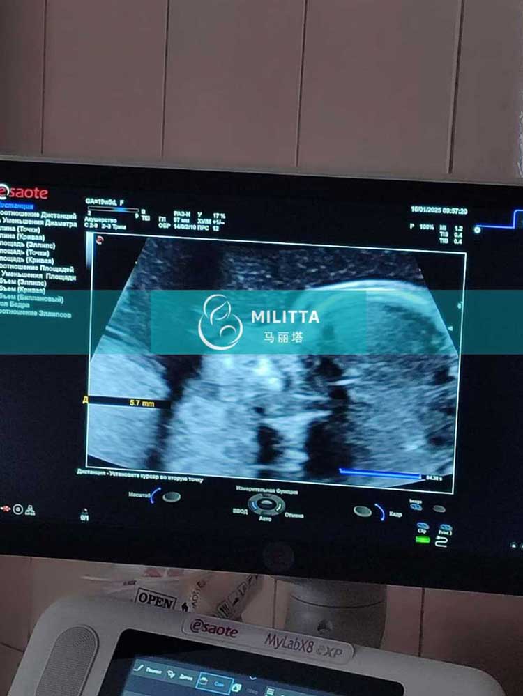 试管妈妈做B超