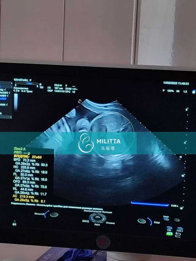 乌克兰试管妈妈做B超