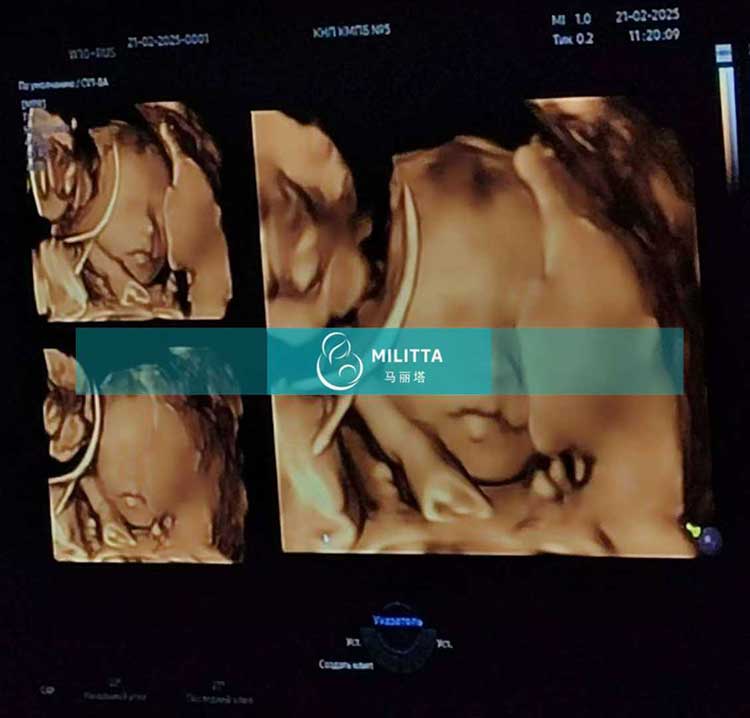 乌克兰试管妈妈做检查