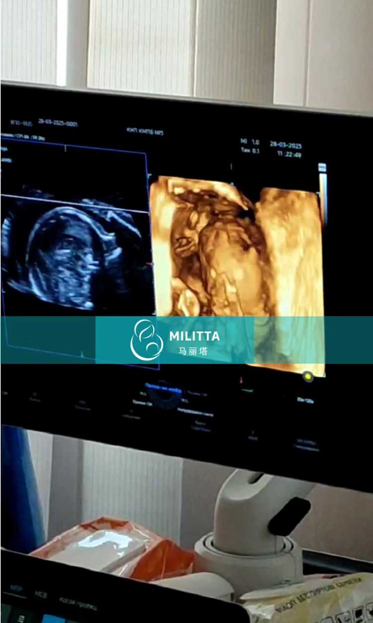乌克兰试管妈妈做四维彩超