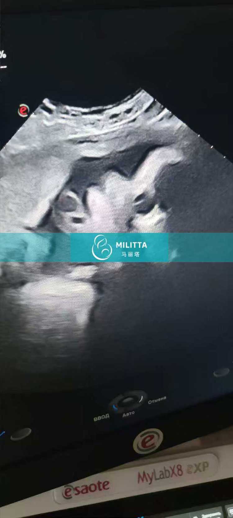 试管妈妈做B超