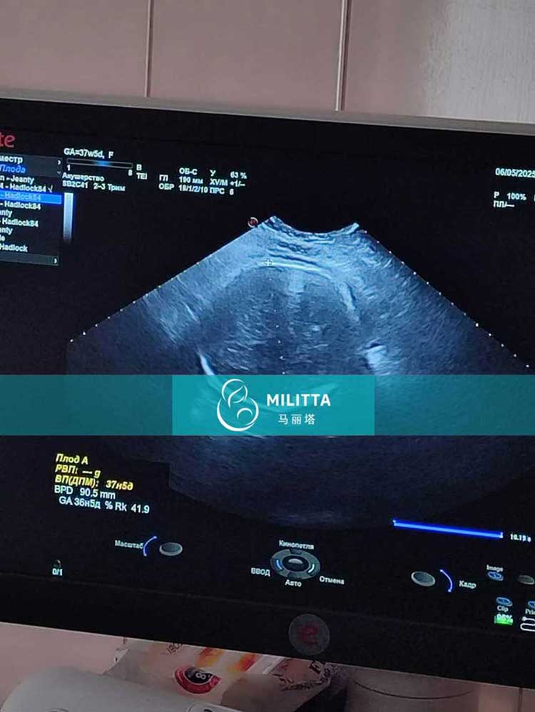 乌克兰试管妈妈做B超