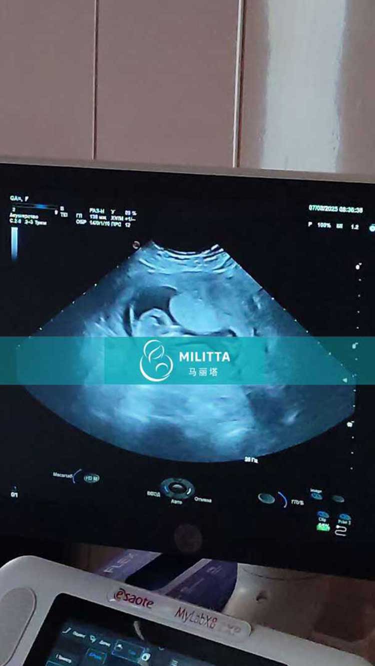 乌克兰试管妈妈做B超