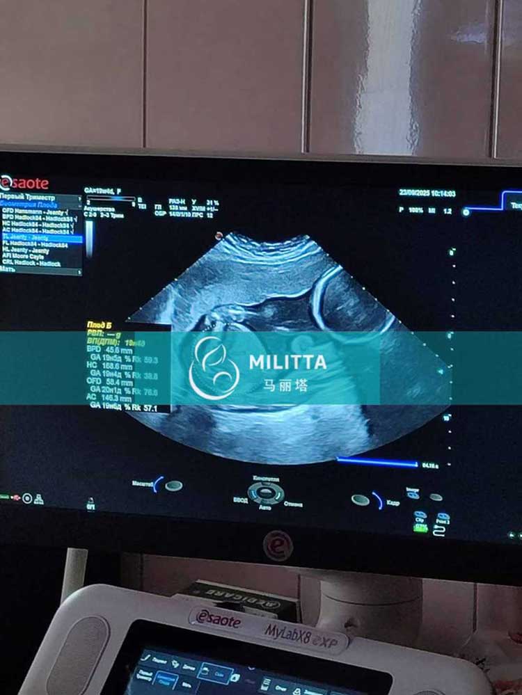 乌克兰试管妈妈做产检