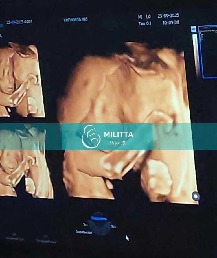 乌克兰试管妈妈做产检