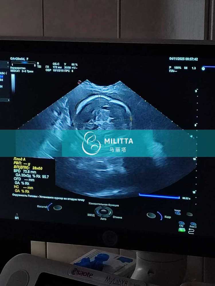 试管妈妈做四维彩超