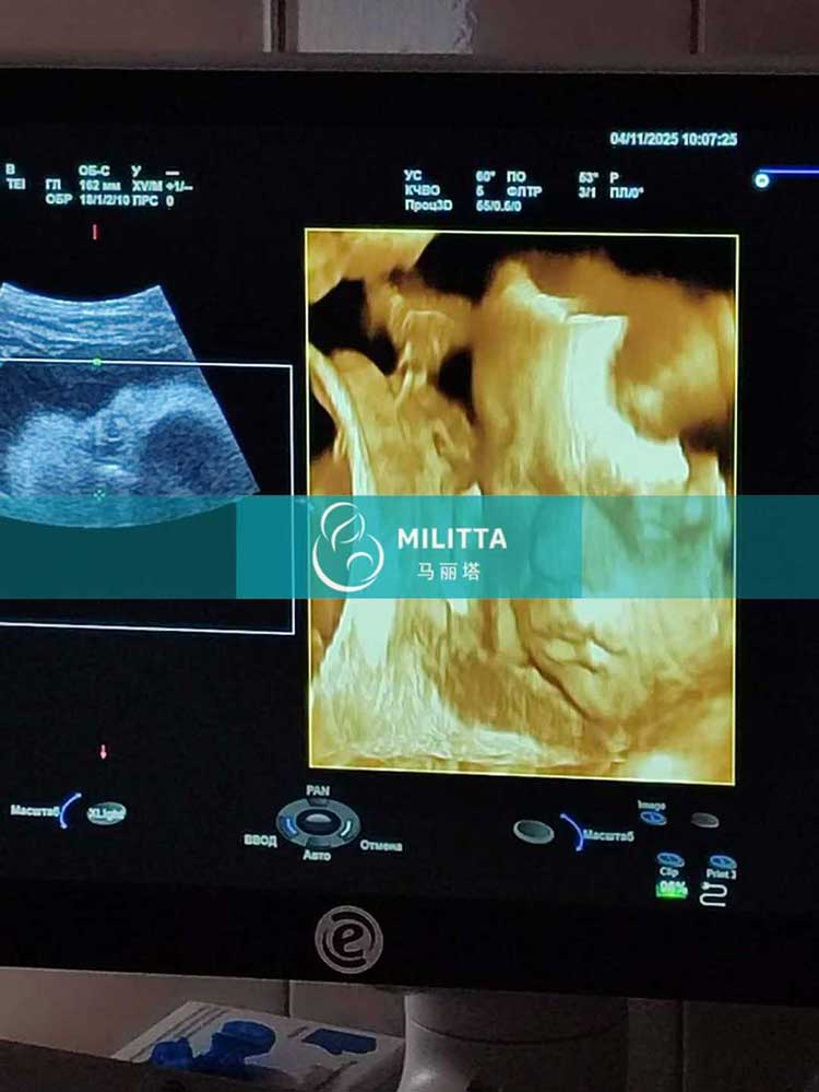 试管妈妈做四维彩超